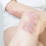 psoriasis-maladie-cutanee-peau-plaque-epaisse-rouge-blog-pn
