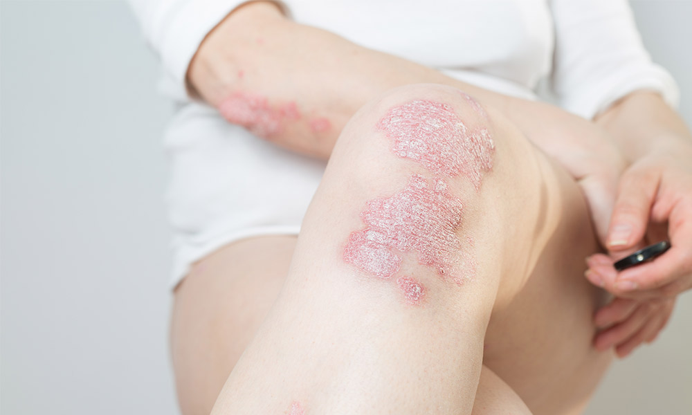 psoriasis-maladie-cutanee-peau-plaque-epaisse-rouge-blog-pn