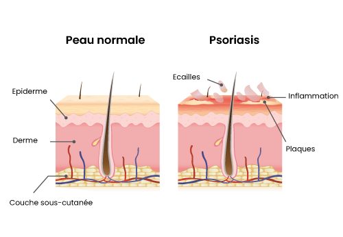 schema-peau-normale-vs-psoriasis-blog-pauline-naturo